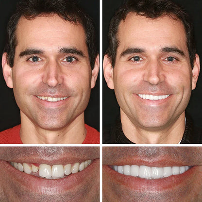 Ends Today: 70% OFF! ⏰ KLENIMORE™ Custom-Fit Smile Support Set — Strong Hold & Natural Look 🦷