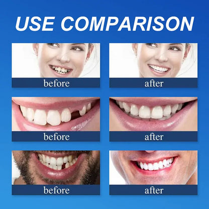 Ends Today: 70% OFF! ⏰ KLENIMORE™ Custom-Fit Smile Support Set — Strong Hold & Natural Look 🦷