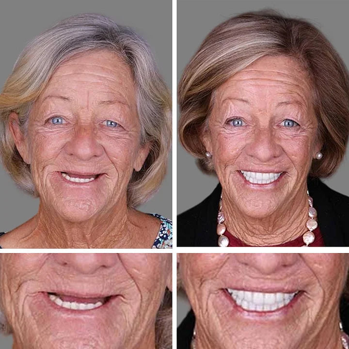 Ends Today: 70% OFF! ⏰ KLENIMORE™ Custom-Fit Smile Support Set — Strong Hold & Natural Look 🦷
