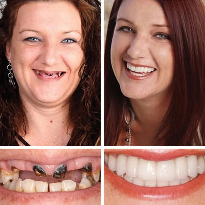 Ends Today: 70% OFF! ⏰ KLENIMORE™ Custom-Fit Smile Support Set — Strong Hold & Natural Look 🦷